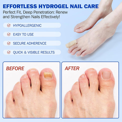 Nyloriaine 42Pcs, (1 Count (Pack 2)) Fungal Nail Patches Toenail Treatment Extra Strength, Nail Repair for Damaged