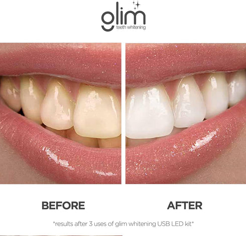 Glim Teeth Whitening Kit for Sensitive Teeth - 36 LED USB Rechargeable Light, Enamel Safe with 4 Gel Pens