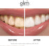 Glim Teeth Whitening Kit for Sensitive Teeth - 36 LED USB Rechargeable Light, Enamel Safe with 4 Gel Pens