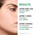 VICHY Normaderm Acne Control Daily Moisturizer, Oil Free Acne Moisturizer for Face, Max Strength 2% Salicylic Acid +