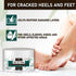 Urea Cream 40 Percent, Intensive Hydration for Dry Cracked Skin, Callus Remover with Salicylic Acid - 4 oz