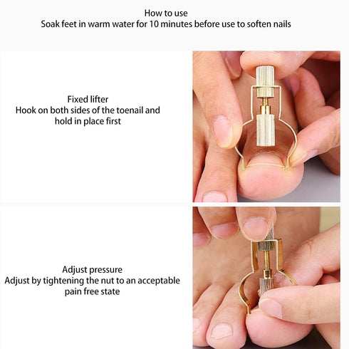 Ingrown Toenail Lifter Tool, Stainless Steel Professional Clamp for Ingrown Toenail Care, Paronychia (Gold)