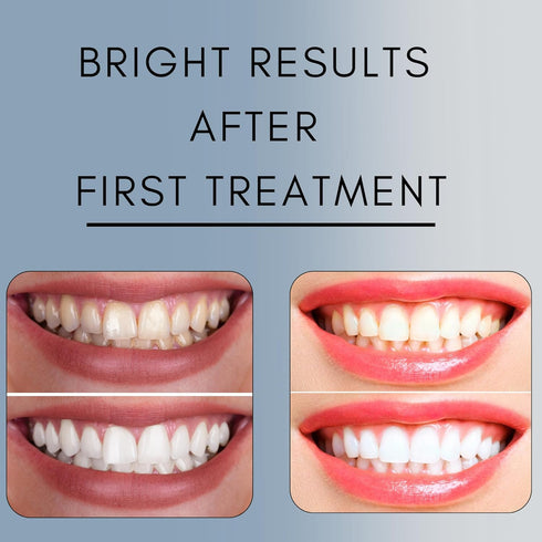 Teeth Whitening Gel Refill for Trays - Professional Strength 44% Carbamide Peroxide Formula for a Brighter Smile