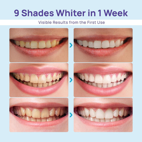 Whitebite Pro Teeth Gel