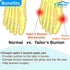 Chiroplax Tailor's Bunion Corrector Pads (4 Pads) for Bunionette Pain Relief, Pinky Toe Straightener