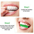 10 Pieces Aligner Trays Seater for Aligner Chompers Orthodontic Dental Aligner (Green)