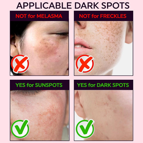 Micropoints for Acne Dark Spot Treatment, 127 Mircropoints Post-Blemish Dark Spots Removal Patch (9 count/pack)