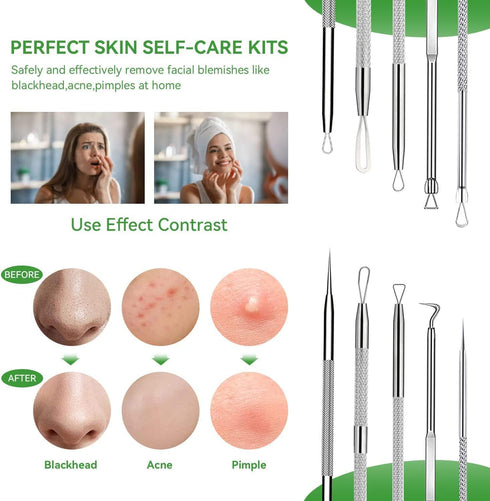 Pimple Popper Tool Kit, 5 Pcs Blackhead Remover Tool for Face, Stainless Steel Extraction Set