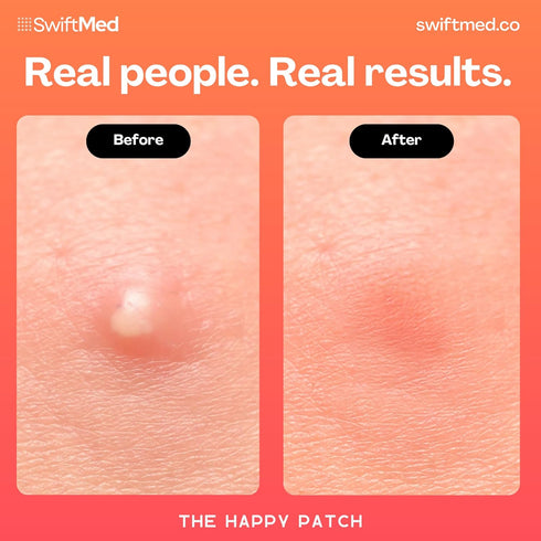 The Happy Patch, Hydrocolloid Acne Patch with Salicylic Acid for Face, Blemishes, Spot Treatment, 100 Count