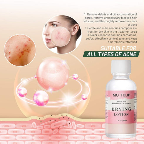 MO TULIP Acne Drying Lotion - Overnight Acne Spot Treatment for Face and Body, 1OZ Pimple Lotion