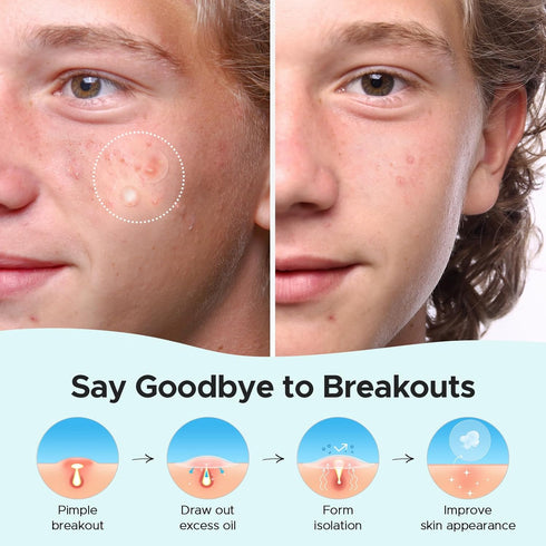 TKTK Hydrocolloid Acne Patches, Pimple Patches with Tea Tree & Calendula Oil - 4 Sizes Clear Stickers, Invisible for