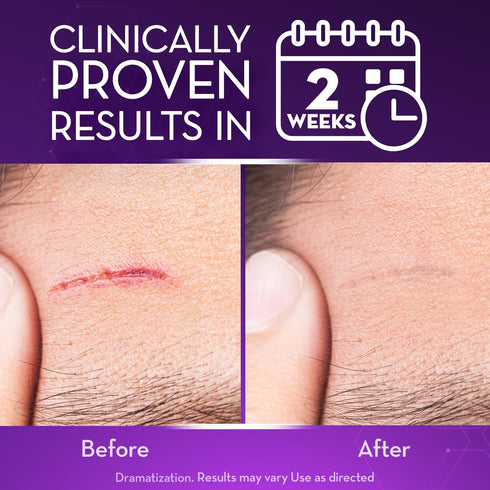 Cicatricure Advanced Scar Gel for Face & Body, Proven Results in 2 Weeks, 1 oz, Scar Treatment for Various Scars
