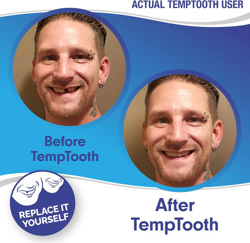 Temptooth #1 Seller, Trusted Patented Temporary Tooth Replacement Product