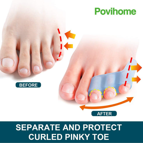 Povihome 10 Pack Pinky Toe Separator for Overlapping Toes, Spacers for Morton's Neuroma Pain Relief
