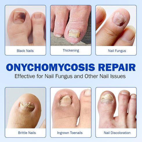 ISUNRISE 21 8-Hour Nail Repair Patches Pcs, Toenail Treatment Extra Strength, Overnight Nail Treatment for Damaged
