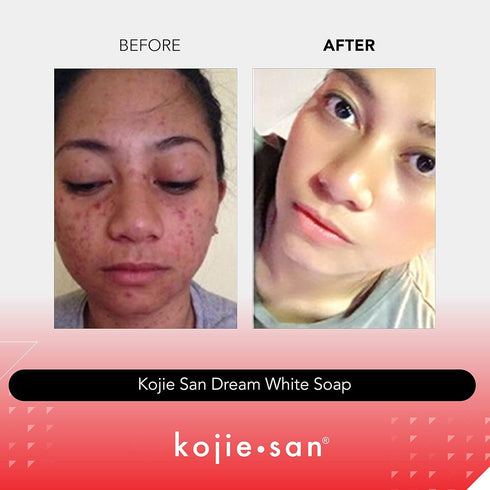 Kojie San Dream White Soap, Skin Brightening & Anti Aging Kojic Acid Soap, 65g x 2 Bars