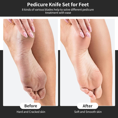 Pedicure Knife Kit, 8pcs Black Foot Dead Callus Remover Stainless Steel Tools for Professional Nail Care