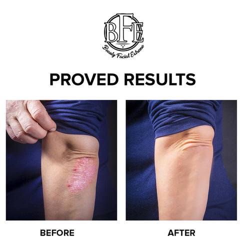 Keratosis Pilaris Exfoliating Body Lotion – 12% Lactic Acid for Gentle Exfoliation & Moisture