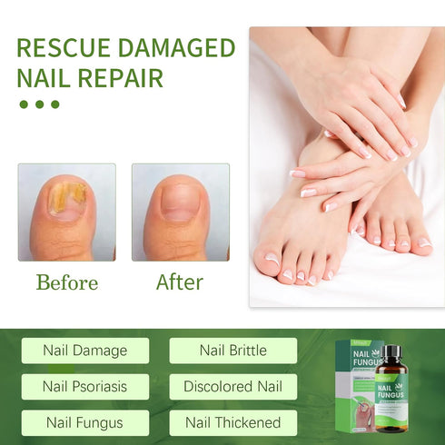 NOXYRAL 7 Toenail Fungus Treatment Extra Strength: Pure Natural Plant ExtractsToe & Fingernail Fungus Renewal - Nail