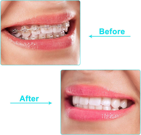 100 Pieces Aligner Trays Seater for Aligner Chompers, Orthodontic Dental Aligner in White, Green, Orange, Pink, and