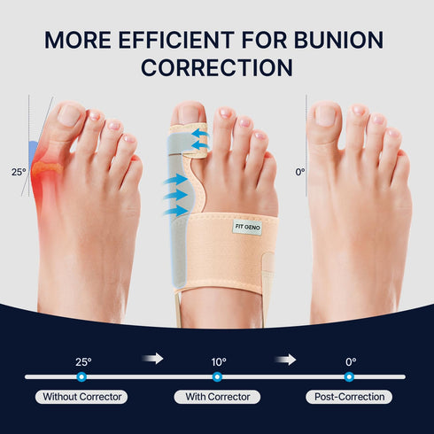 Fit Geno Bunion Corrector, Upgraded Adjustable & Breathable Big Toe Straightener for Day/Night, Non-Surgical Hallux