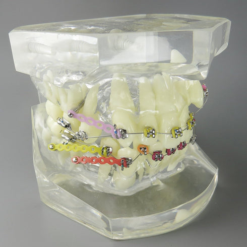 Dental Malocclusion Orthodontic Treatment Teeth Model with Metal Brackets, Colorful Ties, and Chains