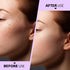 Teenitor Pimple Extractor Tool, Surgical Grade Blackhead Comedone Removal 2-in-1 Popper Tool for Face Nose