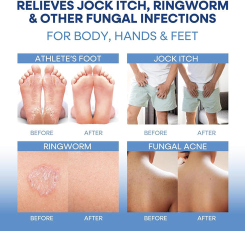 Set 100g 2 Hermon Jock Itch Antifungal Treatment Kit: Relief for Ringworm, Athletes Foot, Tinea Versicolor - Body