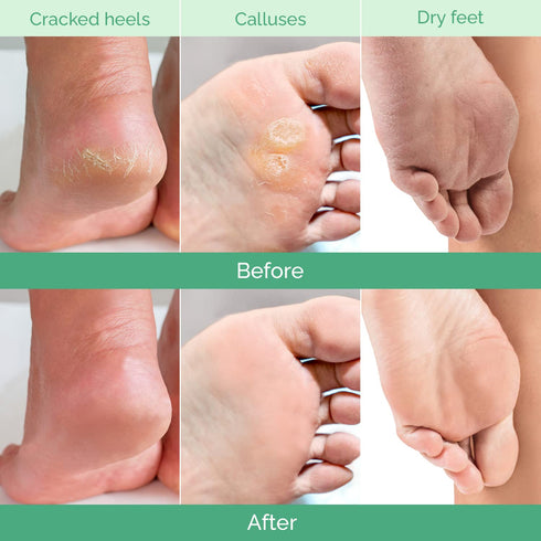 PLANTIFIQUE Jasmine Foot Peeling Mask 1 Pair | Dermatologically Tested for Baby Soft Feet, Repairs Heels & Removes Dry
