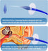 BOCOOLIFE Ear Wax Removal Kit - Safe Ear Cleaning System with 3 Replacement Tips and Wash Basin for Gentle Wax Removal