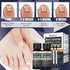 KISMIGER -1% 2 Toenail Fungus Treatment Extra Strength Tolnaftate, Bee Venom Nail Fungus Treatment, Gentle Fungal Nail