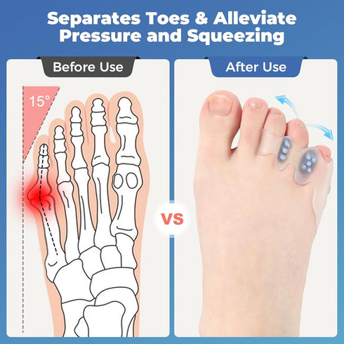 Tailor's Bunion Corrector Kit, Pinky Toe Spacers for Curled Toes and Pain Relief, 1 Pair of Toe Separators and