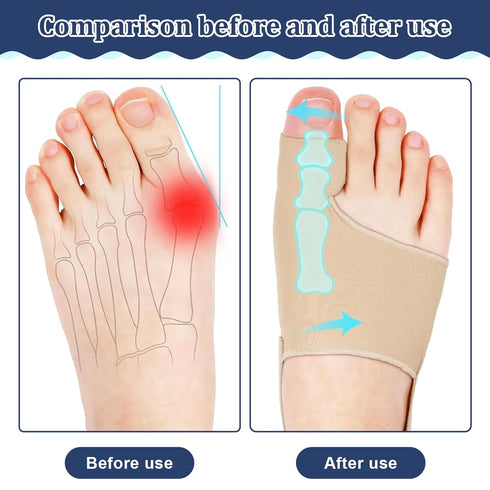 tongtonglovely Professional Bunion Corrector, Orthopedic Toe Separator, Beige, Elastic Fabric, Adjustable Fit, Pain