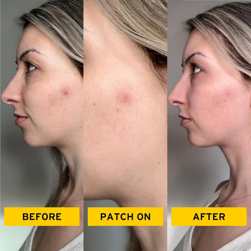 No BS Healing Acne Patches - Hydrocolloid, Acne Spot and Pimple Treatment to Prevent Acne Scars. Invisible On All Skin Tones (1 BOX of 36ct). Includes Free Skincare Samples
