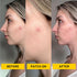No BS Healing Acne Patches - Hydrocolloid, Acne Spot and Pimple Treatment to Prevent Acne Scars. Invisible On All Skin Tones (1 BOX of 36ct). Includes Free Skincare Samples