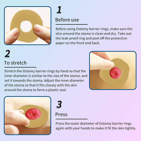 ovand 2 mm 10) Ostomy Barrier Rings - Ostomy Supplies - Thickness Moldable Ostomy Rings Medical Grade Hydrocolloid