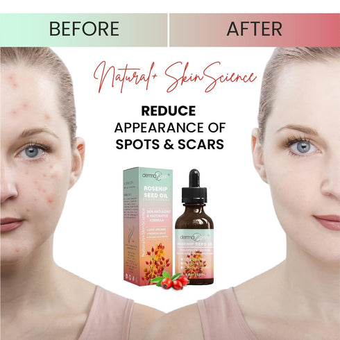 Rosehip Seed Oil 4 Fl Oz, 100% Organic & Cold Pressed Anti-aging Moisturizing Treatment for Face, Hair, Skin & Nails
