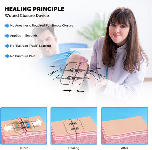 Zip Stitch Emergency Wound Closure Strips, 4 Pcs Laceration Closure Kit for Wounds without Stitches, Butterfly Bandaids