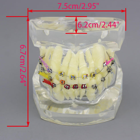 Dental Malocclusion Orthodontic Treatment Teeth Model with Metal Brackets, Colorful Ties, and Chains