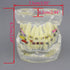 Dental Malocclusion Orthodontic Treatment Teeth Model with Metal Brackets, Colorful Ties, and Chains