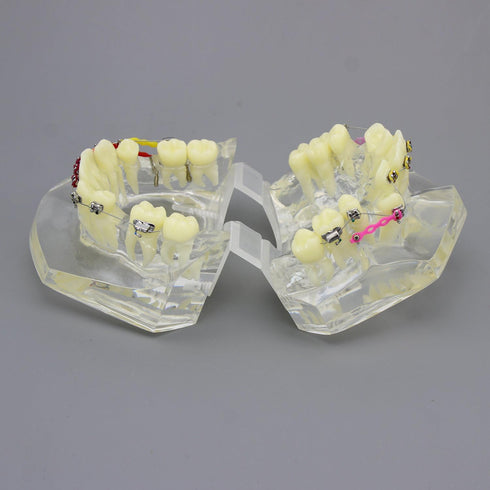Dental Malocclusion Orthodontic Treatment Teeth Model with Metal Brackets, Colorful Ties, and Chains