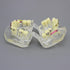 Dental Malocclusion Orthodontic Treatment Teeth Model with Metal Brackets, Colorful Ties, and Chains