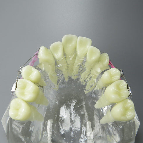 Dental Malocclusion Orthodontic Treatment Teeth Model with Metal Brackets, Colorful Ties, and Chains