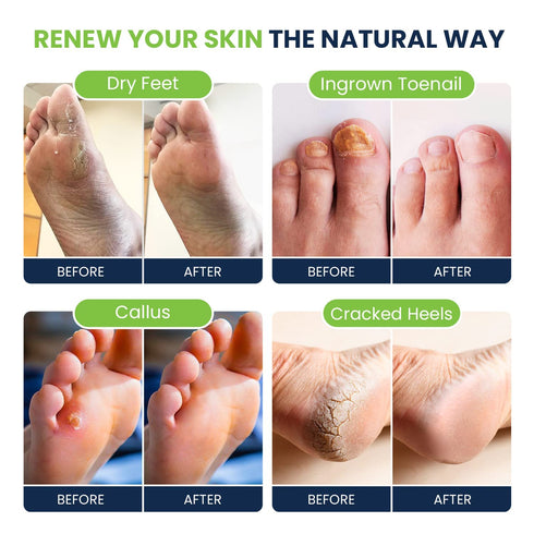 Tea Tree Oil Foot Soak with Epsom Salt, 16 oz - For Toenail Repair, Athletes Foot, Spa Care