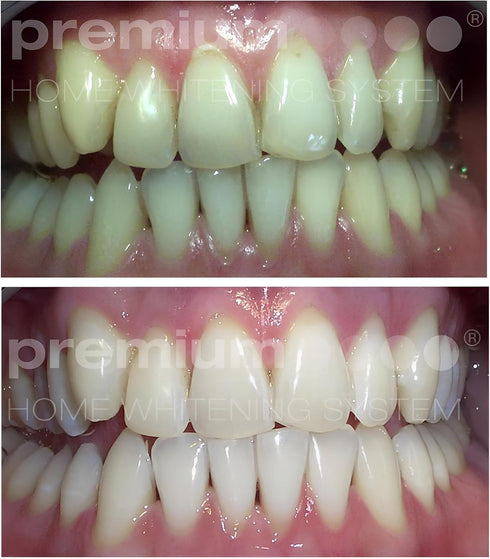 Premium Home Whitening System Premium Home Teeth Whitening Kit