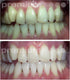 Premium Home Whitening System Premium Home Teeth Whitening Kit