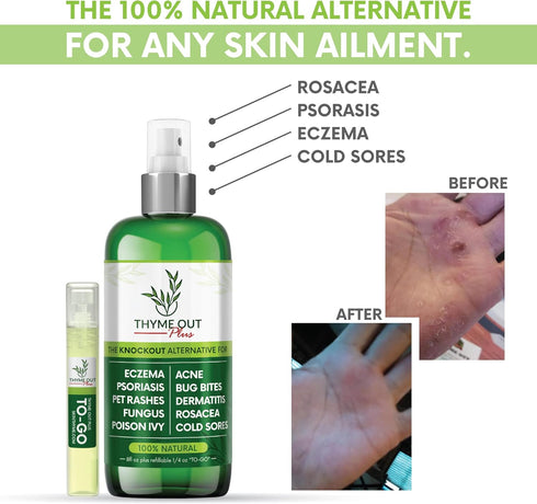 Thyme Out Plus Eczema Treatment, Psoriasis Treatment Treats Acne, Dermatitis, Rosacea, Cold Sores, Pet Rashes, Bug