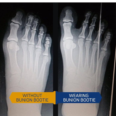 Bunion Corrector for Women - Big Toe Straightener, Ultra-Thin, Discreet Sock for Hallux Valgus Relief