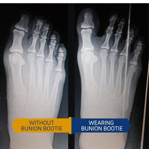 Bunion Corrector for Women - Big Toe Straightener, Ultra-Thin & Discreet Sock for Hallux Valgus Relief (XSmall-Right)