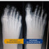 Bunion Corrector for Women - Big Toe Straightener, Ultra-Thin & Discreet Sock for Hallux Valgus Relief (XSmall-Right)